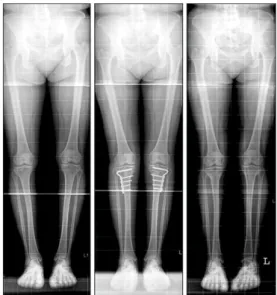 Figure 1. Visual analogue scale score. Preop, preoperative; Postop,  postoperative; CWO, closing-wedge osteotomy; OWO, opening-wedge  osteotomy.