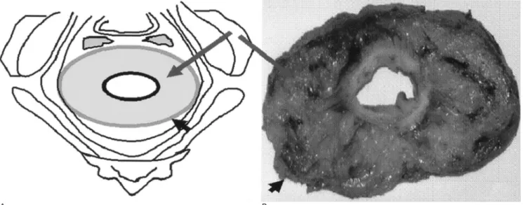 Fig. 1. A diagram and surgical specimen of the normal mesorectum and mesorectal fascia