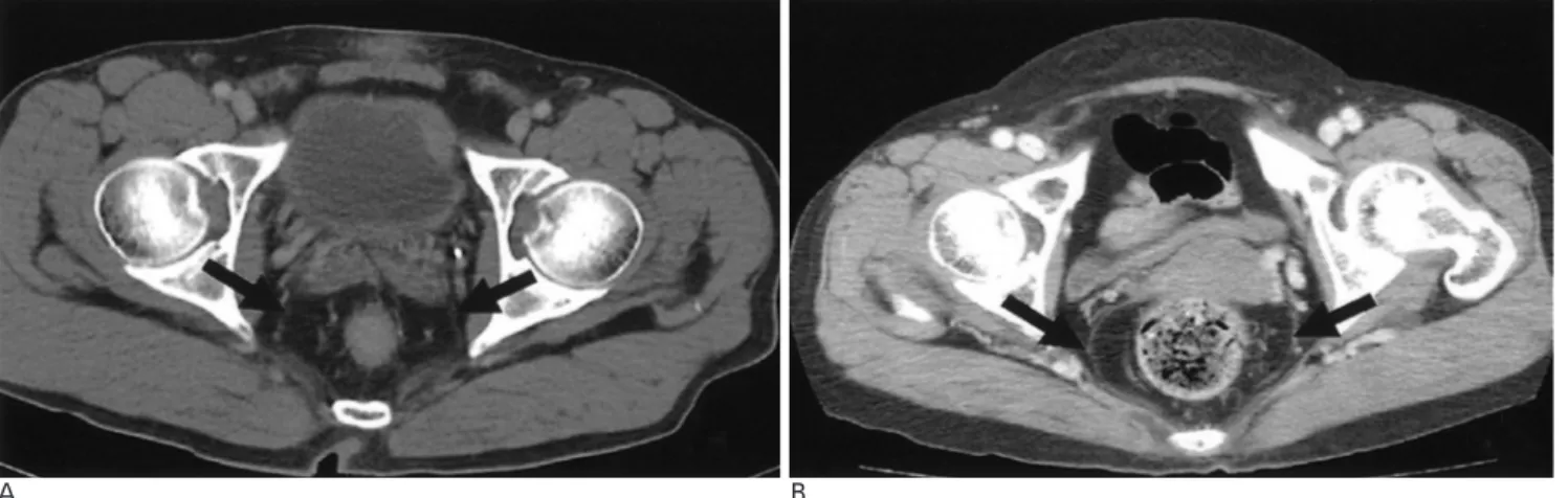 Fig. 2. The normal mesorectum and mesorectal fascia on axial MDCT scans in a male (A) and female (B) patient