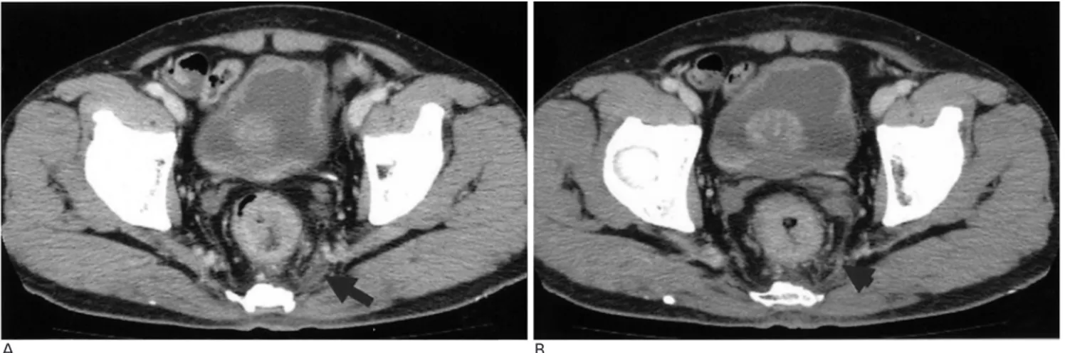 Fig. 5. An false positive CRM due to partial volume averaging in a 70-year-old man.