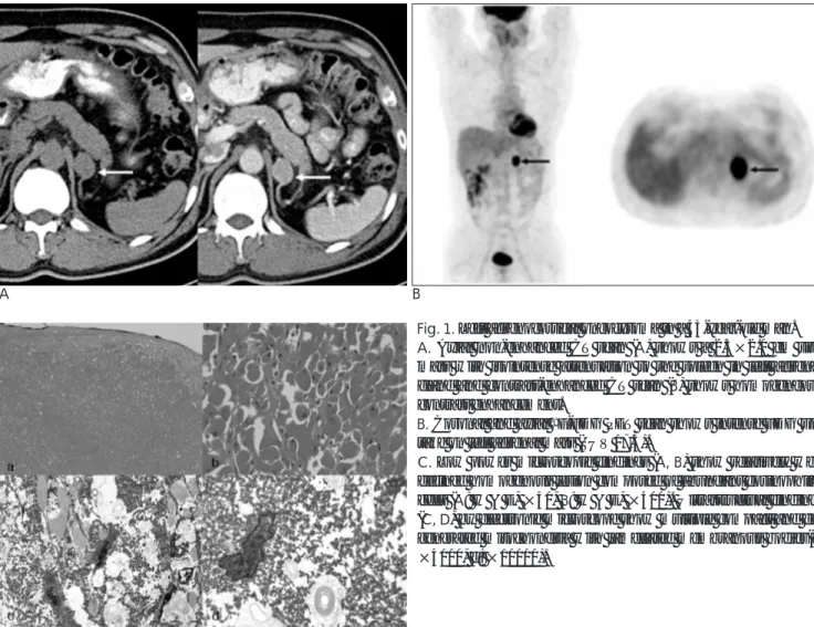 Fig. 1. Left adrenocortical oncocytoma in a 43-year-old man.