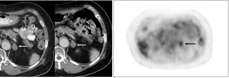 Fig. 2. Left adrenal mass in a 70-year-old female with a history of breast cancer.