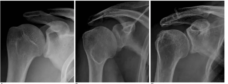 Fig. 1. Gradings of degenerative changes in acromion and greater tuberosity.