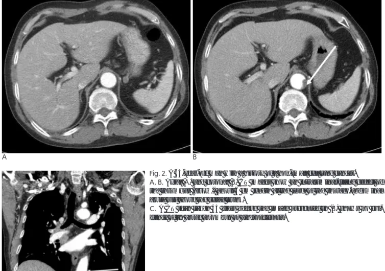 Fig. 2. A 65-year-old man with a history of a non-small cell lung cancer.