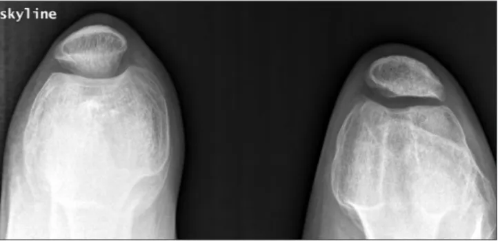 Figure 5. The follow-up radiograph taken 6.5 years after the 1st  operation (2.5 years after 2nd operation) shows a developed trochlear  groove and a well located patella on the Merchant view.