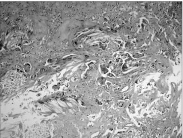 Figure 2. The excised specimen was cut. Retained sponge material was  found within the thick capsule of the paraspinal mass.