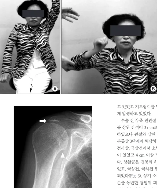 Figure 2. Pre-operative radiograph shows typical appearance of cuff  tear arthropathy; decreased acromio-humeral interval (white arrow) and  superior migration (white triangle).