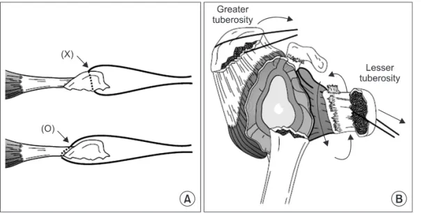 Figure 2. The anterior fin of the prosthesis is aligned with the forearm  in neutral rotation, and the lateral fin is positioned approximately 8  mm posterior to the biceps groove, establishing a retroversion angle of  approximately 30 degrees.