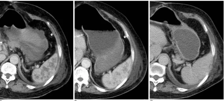 Fig. 2. A. Delayed phase CT scan taken on 6th days after embolization shows a geographic low density lesion in the central portion of the spleen.