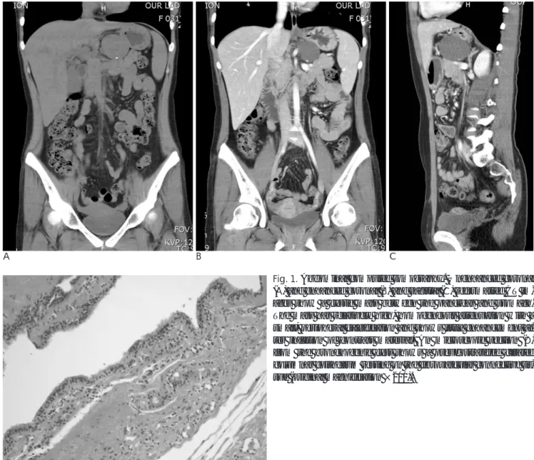 Fig. 1. Abdominal computed tomography. Unenhanced coronal (A) and enhanced coronal (B) and sagittal (C) reformatted CT  im-ages show a cystic mass between the pancreas and stomach.