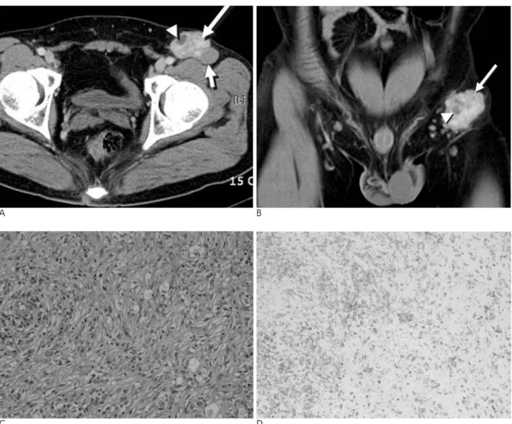 Fig. 1. A 35-year-old man with inflammatory pseudotumor of the inguinal lymph node.