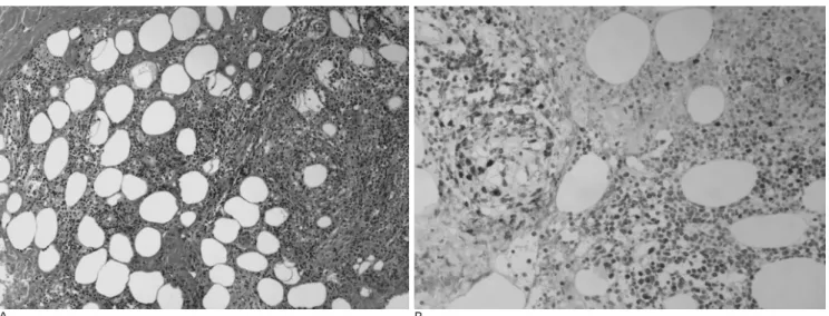 Fig. 2. A. Subcutaneous adipose tissues are surrounded by tumor cells. The right lower corner reveals a granulomatous reaction.