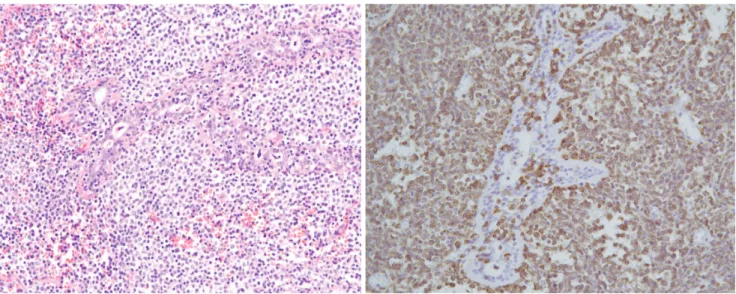 Fig. 1. E. A photomicrograph shows diffuse infiltration of small and large lymphoid tumor cells in and around the breast duct (H &amp;