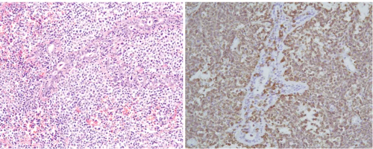 Fig. 1. E. A photomicrograph shows diffuse infiltration of small and large lymphoid tumor cells in and around the breast duct (H &amp;