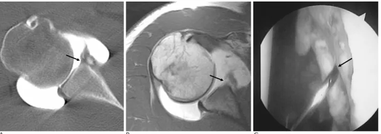 Fig. 1. Right shoulder of a 19-year-old man who suffered with recurrent shoulder dislocations for 3 years.