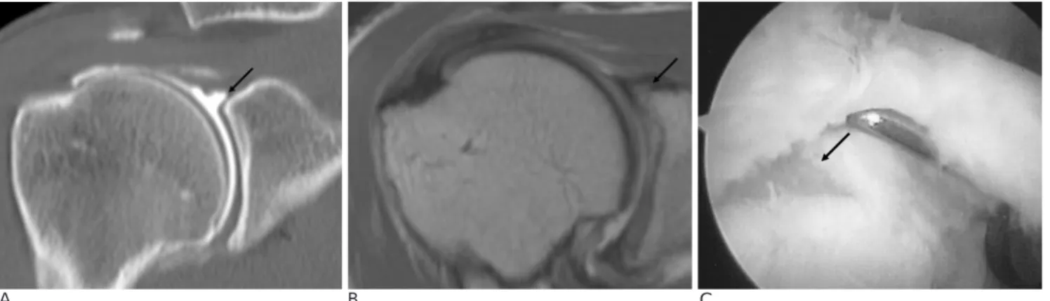 Fig. 3. Right shoulder of a 46-year-old man who suffered with chronic anterior shoulder dislocation for 10 years after an injury playing volleyball.