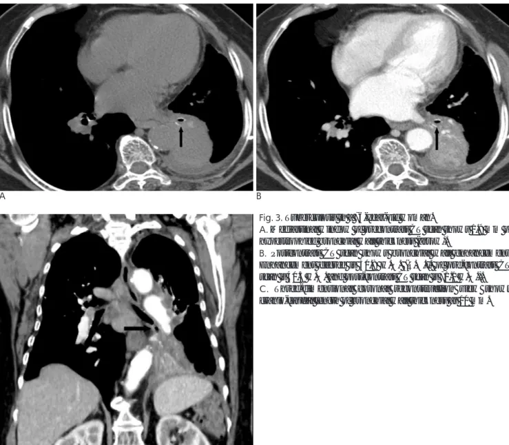 Fig. 3. Tuberculosis in a 76-year-old woman.