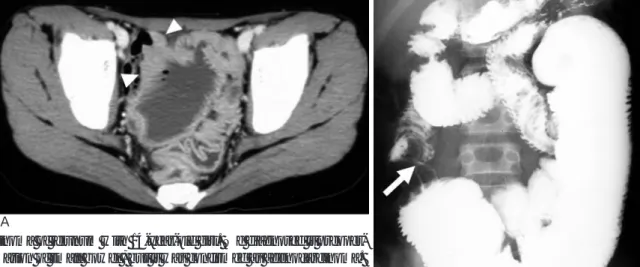 Fig. 4. Transmesenteric internal hernia in 10-year-old boy. We diagnosed it preoperatively as small bowel obstruction with strangu- strangu-lation caused by small bowel volvulus 