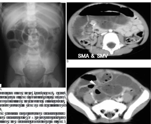 Fig. 5. Idiopathic bands formation with in 4-year-old boy. We diag- diag-nosed it preoperatively as small bowel volvulus, but it was  con-firmed by closed loop obstruction with idiopathic multiple bands