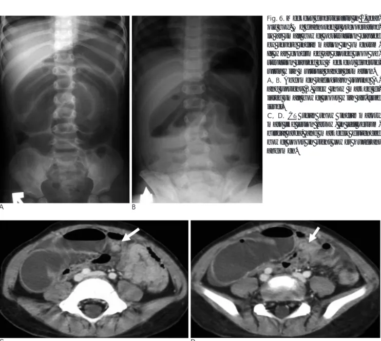 Table 1. CT Predictability and Findings of Small Bowel Obstruction