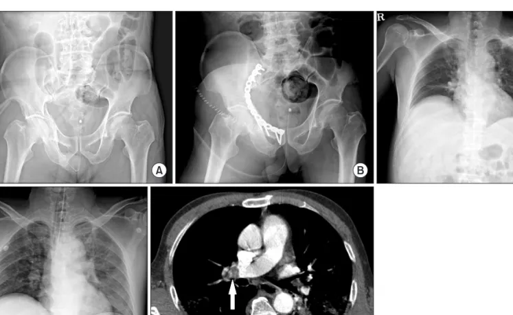 Figure 1. (A) Initial pelvis antero-posterior (AP) radiograph of a 55-year-old man with injury severity score 22; liver laceration, T12 compression  fracture, right acetabular fracture and 2 nd  degree burn on the right arm