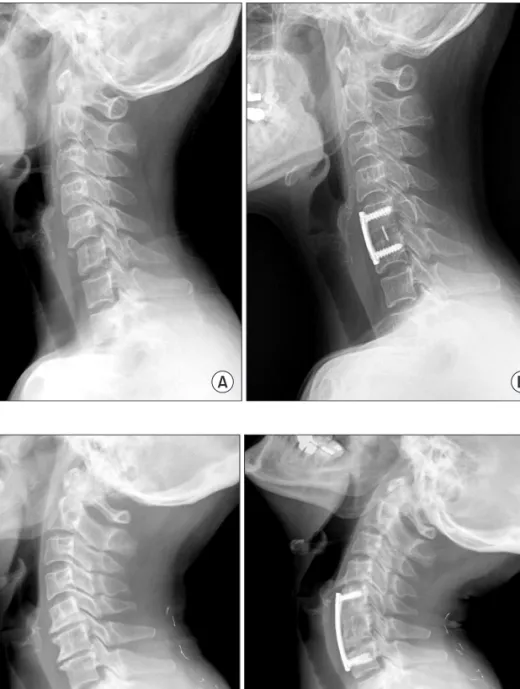 Figure 2. A 61-year-old female patient  had  anterior  cervical  discectomy  and  fusion with Polyethyletherketone (PEEK)  cage  (Stryker  spine,  USA)  packed  with  autogenous iliac bone and plate  stabiliz-ation for unilateral facet dislocstabiliz-ation