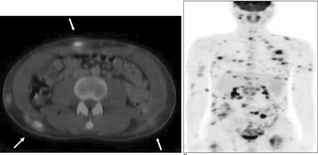 Fig. 3. A. Axial fused FDG-PET/CT images show multiple focal FDG uptake lesions (arrows) in subcutaneous layer of abominal wall and back.