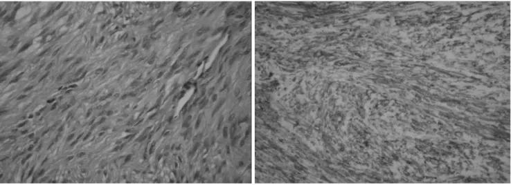 Fig. 1. E. The H &amp; E staining shows monomorphic spindle cells without significant cellular pleomorphism and mitotic activity (×