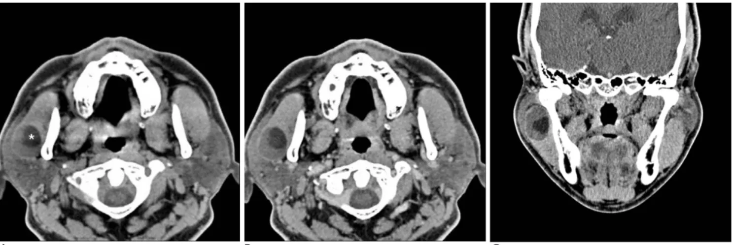 Fig. 2. Gross specimen from right superficial parotidectomy. 