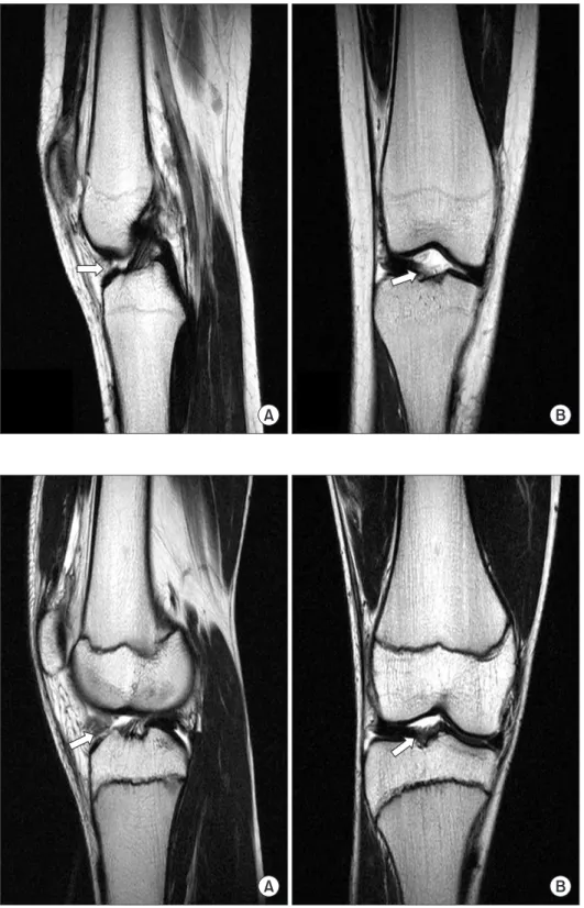 Figure  3.  (A)  (B)  Case  1.  MR  images  taken  20  months  after  surgery  show  disappearance  of  mass  compared  with  preoperative MR.
