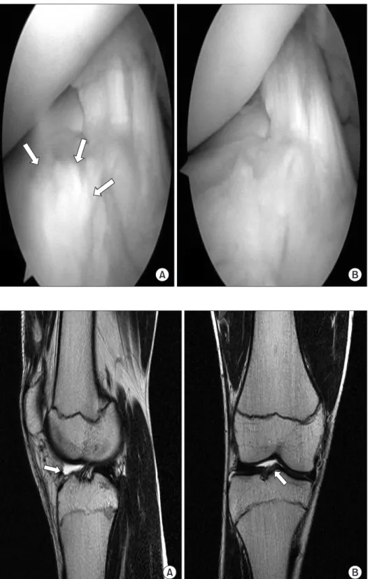 Figure 6. Sagittal (A) and coronal (B) T2- T2-weighted MR images taken 17 months  after surgery show disappearance of scar  tissue compared with preoperative MR.