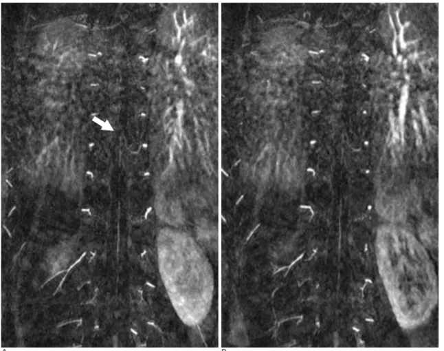 Fig. 1. Coronal maximum intensity projection (MIP) images of acquisition of coronal section, a 20-year-old male with radiculopathy