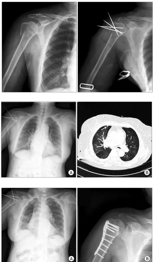 Figure 1. Preoperative and immediate  postoperative  radiographs  of  right  shoulder