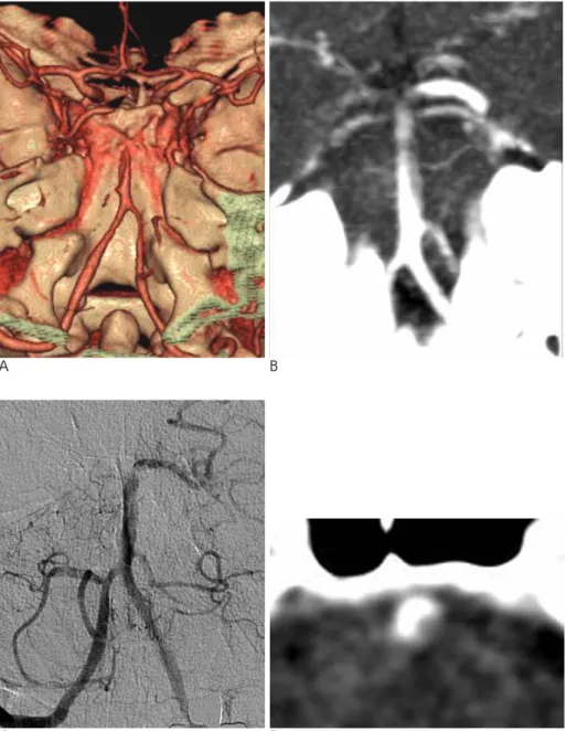 Fig. 2. Sterno-occlusive type basilar artery dissection in a 42-year-old man with neck pain, dysarthria and right side weakness