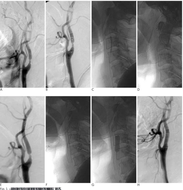 Fig. 1. Stenting procedure using Filterwire. 