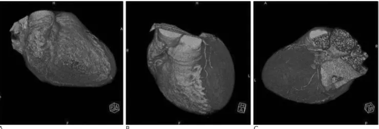 Fig. 1. A 45-year-old man underwent coronary CTA without administration of sublingulal NTG