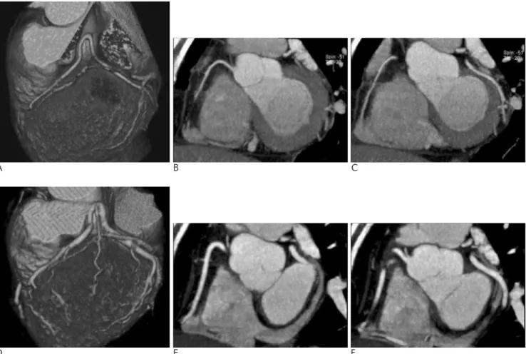 Fig. 2. A 54-year-old female underwent an initial coronary CTA (A-C) without NTG administration