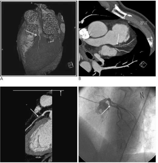 Fig. 3. A 55-year-old man underwent coronary CTA without NTG  adminis-tration. The volume-rendering image (A) shows significant lumen reduction (arrow) at the mid-LAD