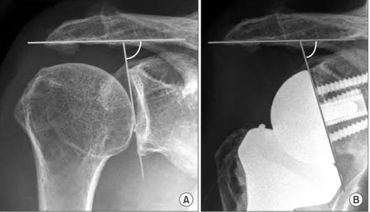 Figure 3. Glenoid tilting increased  comparing pre-operative x-ray(A) to  post-operative x-ray.