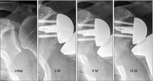 Figure 4. Scapular notching occurred  inferior to the glenoid hemisphere at 6  months postoperatively