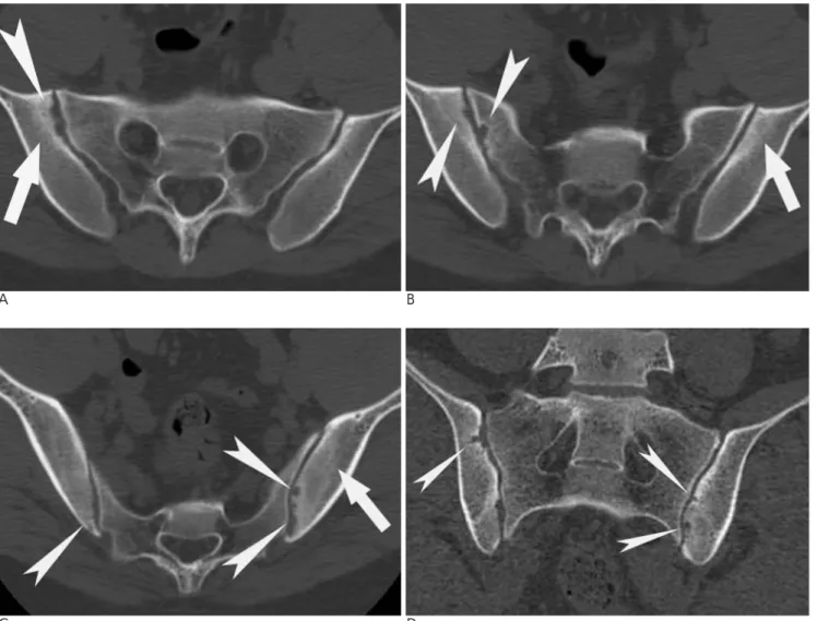 Fig. 3. A 23-year-old man with ankylosing spondylitis (AS group).