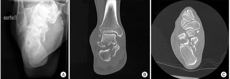 Figure 6. Postoperative radiographs showing the internal fixation with headless compression screws.