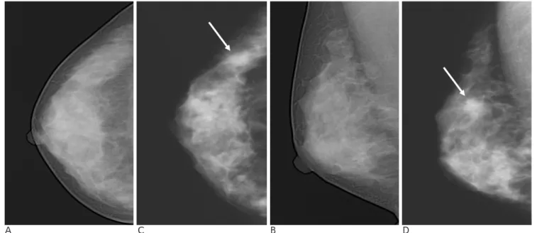Fig. 2. True positive screening mammogram