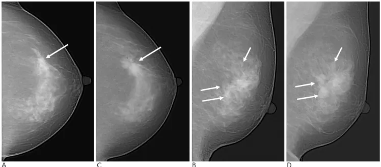 Fig. 4. False negative screening mammogram due to misperception: findings obscured by overlying tissue
