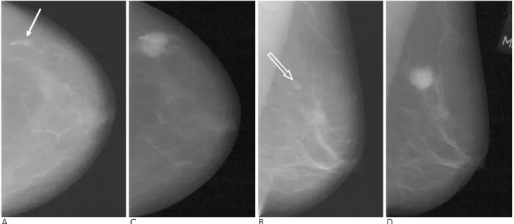 Fig. 6. False negative screening mammogram due to misinterpretation: loose application of category 3