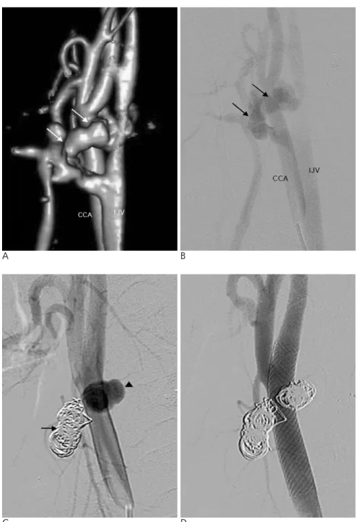 Fig. 2. Case 2. A, B. 3D CTA (A) and DSA (B) reveal a fistula (arrows)  be-tween the distal common carotid artery and IJV