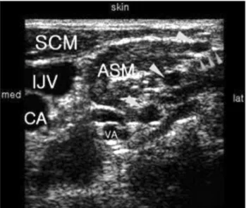 Figure 1. The photograph shows injection points of interscalene block. 