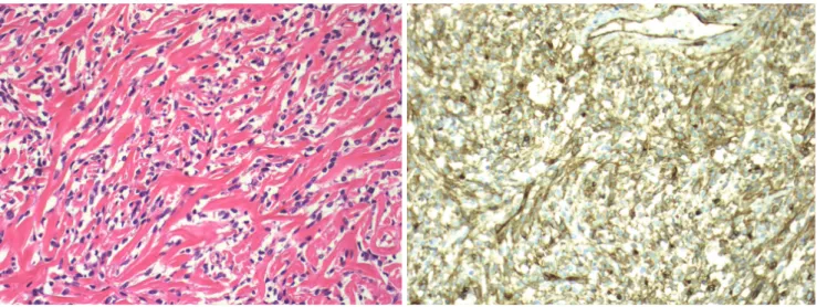 Fig. 3. A. Photomicrograph shows the tumor is composed of a haphazard proliferation of spindle cells separated from the hyalin- hyalin-ized collagen tissue (H &amp; E, ×200)