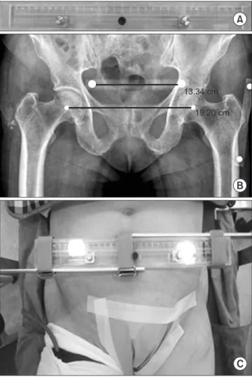 Figure 3. A radiograph was taken after positioning of the patient  before surgery. We measured horizontal distance from the peg to the  perpendicular extending line through the line of the femoral head center.