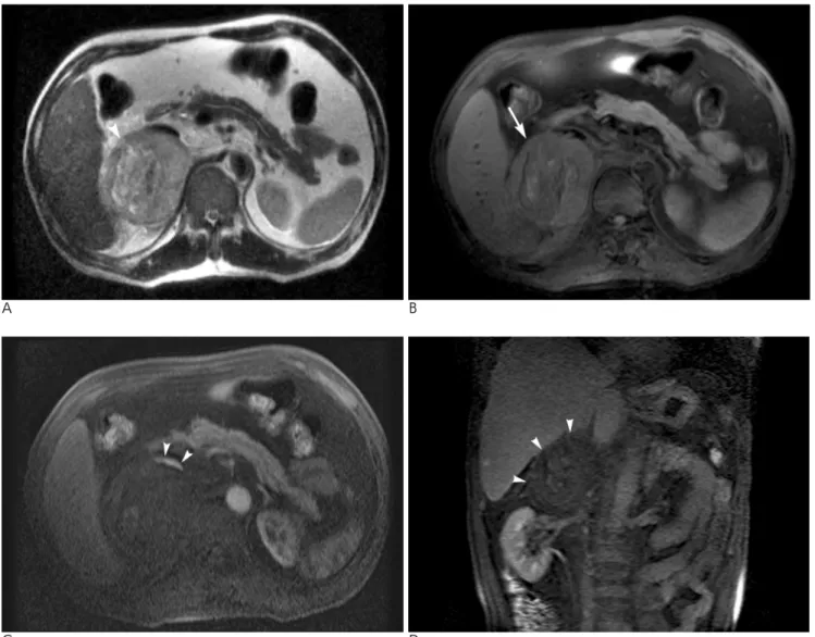 Fig. 2. Abdominal MRI of a 53-year-old man with right adrenal metastasis from hepatocellular carcinoma.